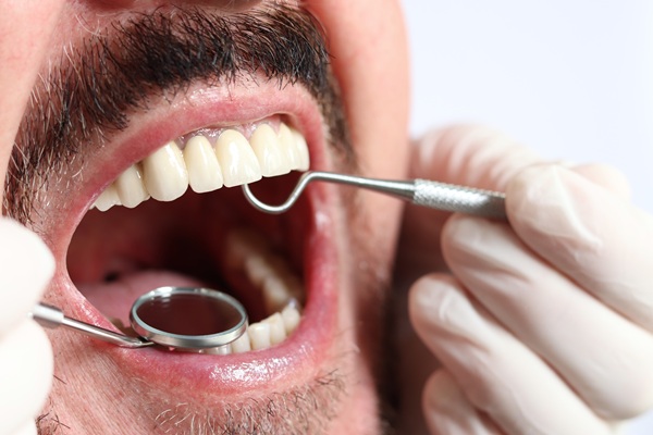 How Professional Cavity Treatment Can Prevent The Spread Of Tooth Decay