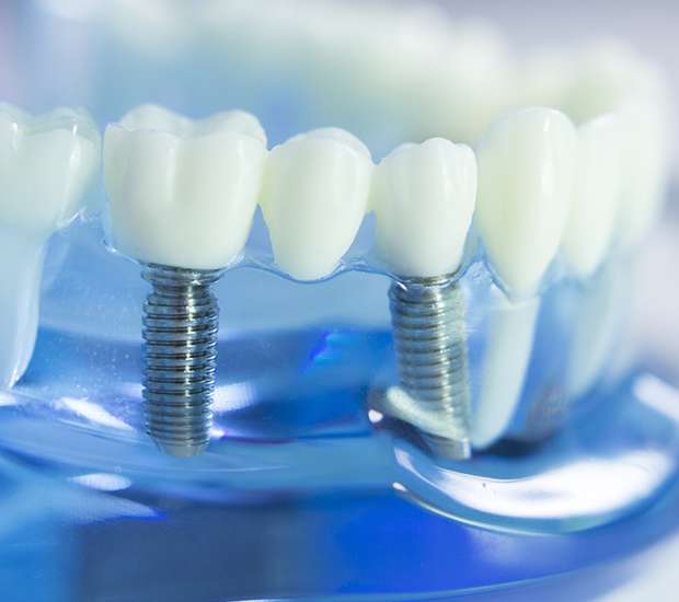 Pataskala Dental Implants