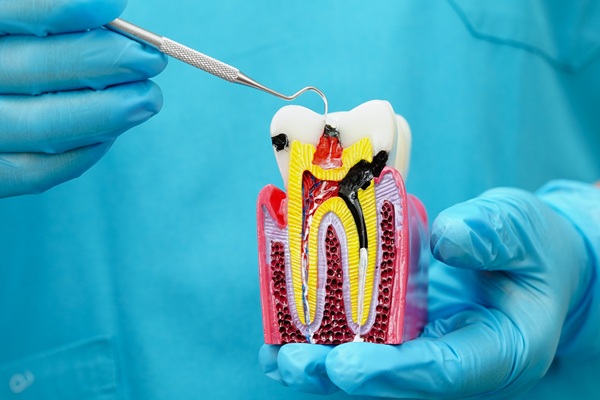 Possible Complications Of Root Canals And How To Avoid Them